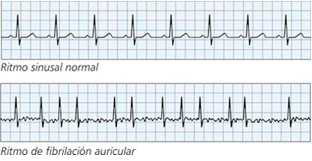 ECG_RSN_FA